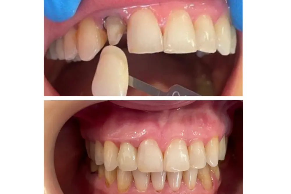 dentaldermaart-drauroraborodi-consultatie